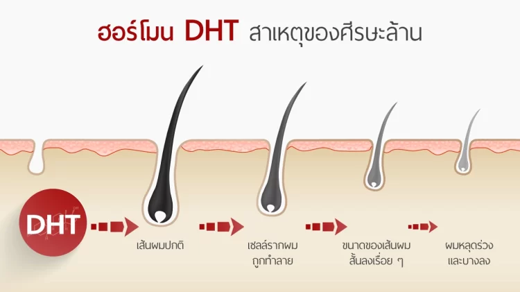 Hormone DHT สาเหตุของศีรษะล้าน - สาระน่ารู้จาก Jhair